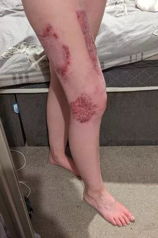 口袋里的电子烟起火后,妈妈的腿“烧得酥脆”
